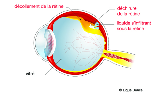 Schéma de l'oeil atteint d'un décollement de la rétine