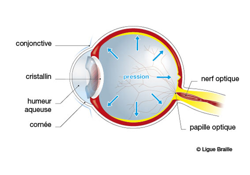 Schéma de l'oeil atteint de glaucome