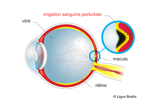 Schéma de l'oeil atteint de maculopathie diabétique