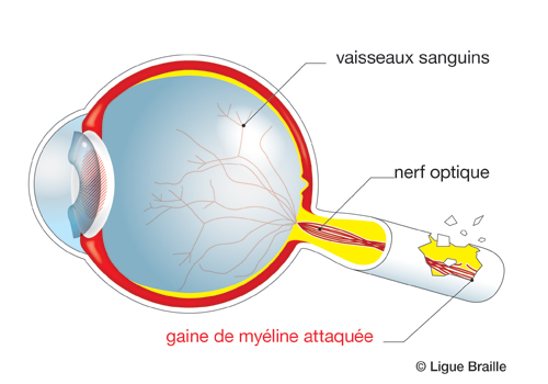 Schéma de l'oeil atteint de névrite optiques