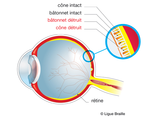 Schéma de l'oeil atteint de rétinite pigmentaire