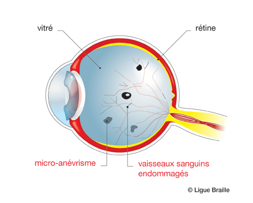 Schéma de l'oeil atteint de rétinopathie diabétique