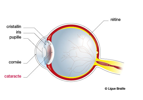Schéma de l'oeil atteint de cataracte