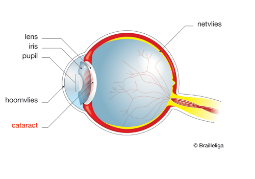 Schema van een oog getroffen door cataract.