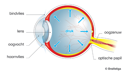 Schema van een oog getroffen door glaucoom