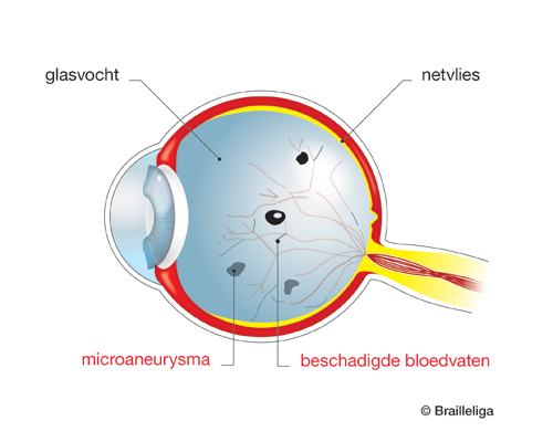 Schema van een oog getroffen door diabetische retinopathie